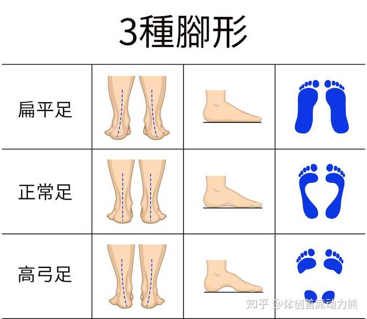 扁平足纠正鞋垫对于成年人是否有用 知乎