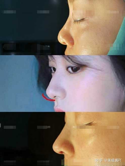 做鼻综合是什么体验 知乎