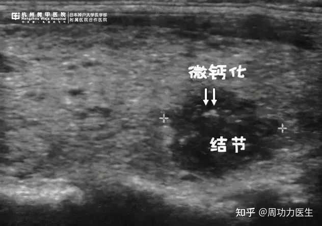 如何理解甲状腺结节钙化,血流丰富? - 知乎