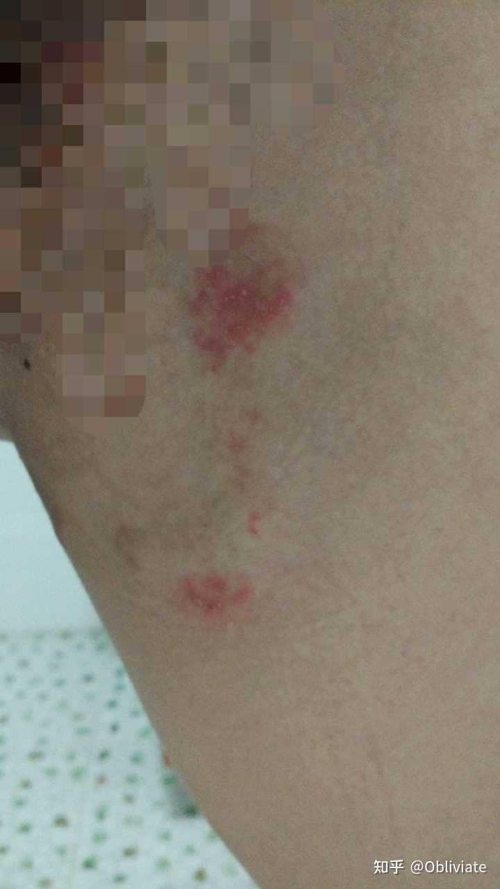 大腿内侧从根部长痘痘是怎么回事?两边都有 痒 抓了更痒? - 知乎