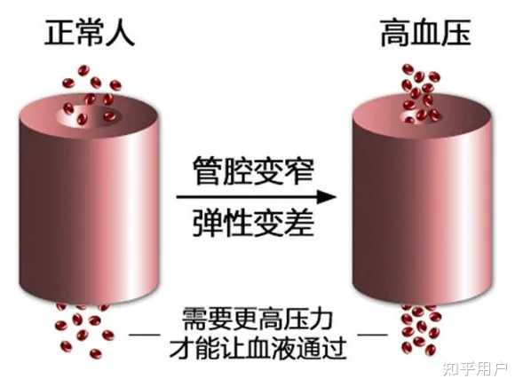 高血压的发生原理是什么? - 知乎
