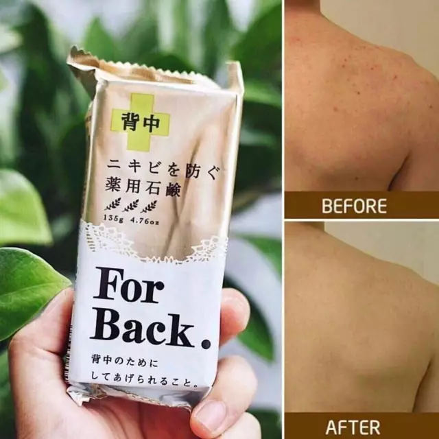 要怎么有效去除后背的痘痘和痘印 知乎 要怎么有效去除后背的痘痘和痘印 知乎