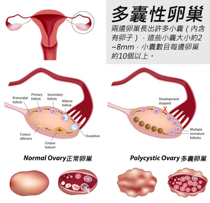 多囊卵巢能做试管婴儿吗? - 知乎