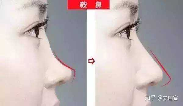 什么样的鼻子算塌鼻子啊? - 知乎