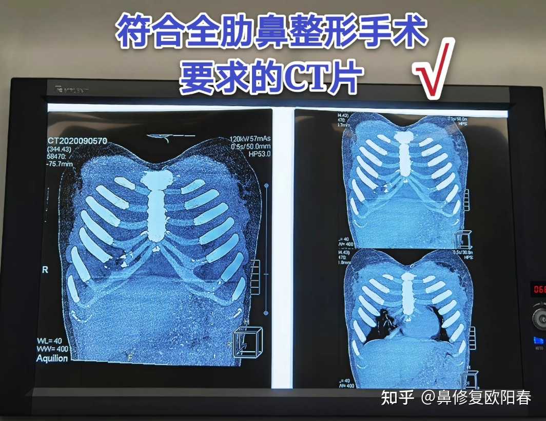 的ct片成像不清晰肋软骨边界模糊不清晰有些甚至无法准确判断钙化情况