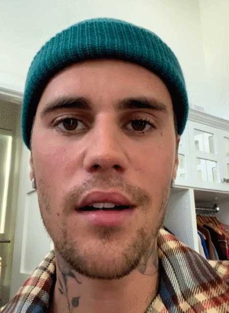 贾斯汀比伯患亨特氏综合征右脸面瘫引网友围观这病有多严重