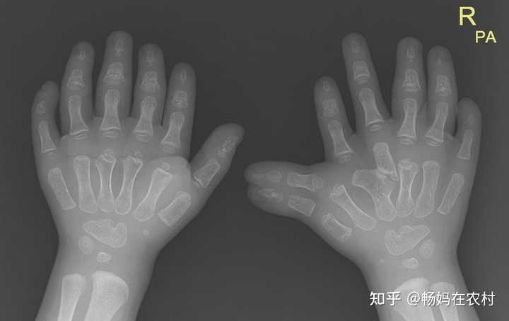 有的人会长六根手指(能正常使用的那种),这算不算是人类的进化呢? - 知乎