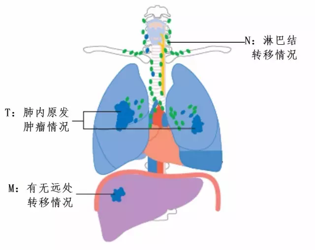 肺癌加淋巴结转移算什么期间，早期？中期？还是晚期？