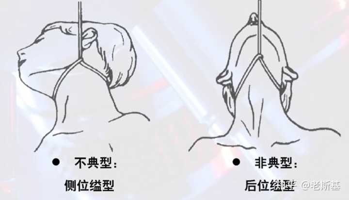典型缢死和非典型缢死的区别是什么? - 知乎