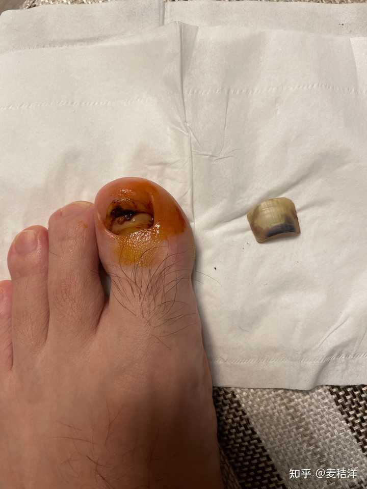 踢球脚趾甲掉了怎么办 知乎