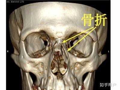 鼻骨骨折消肿后的复位是怎样进行的 如何矫正 知乎