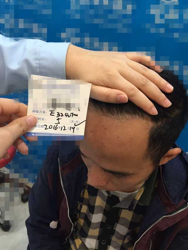 有知友做过植发吗，效果如何？
