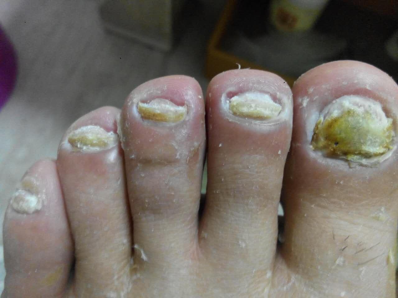 灰指甲治疗四十天了每天用大蒜醋泡脚每天用亮甲隔一天修指甲上药现在