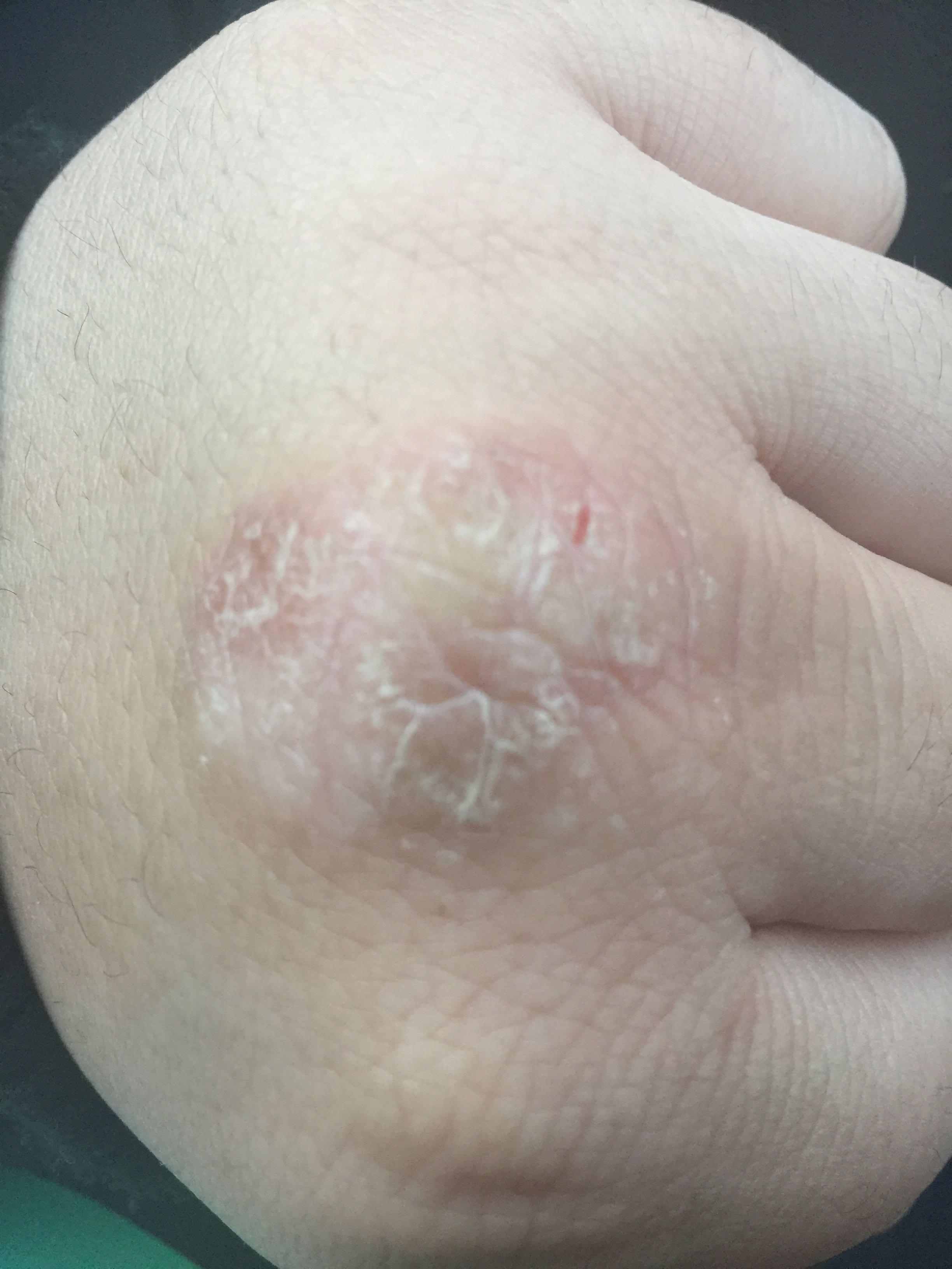 左手骨节处皮肤有一元硬币大小结痂裂口