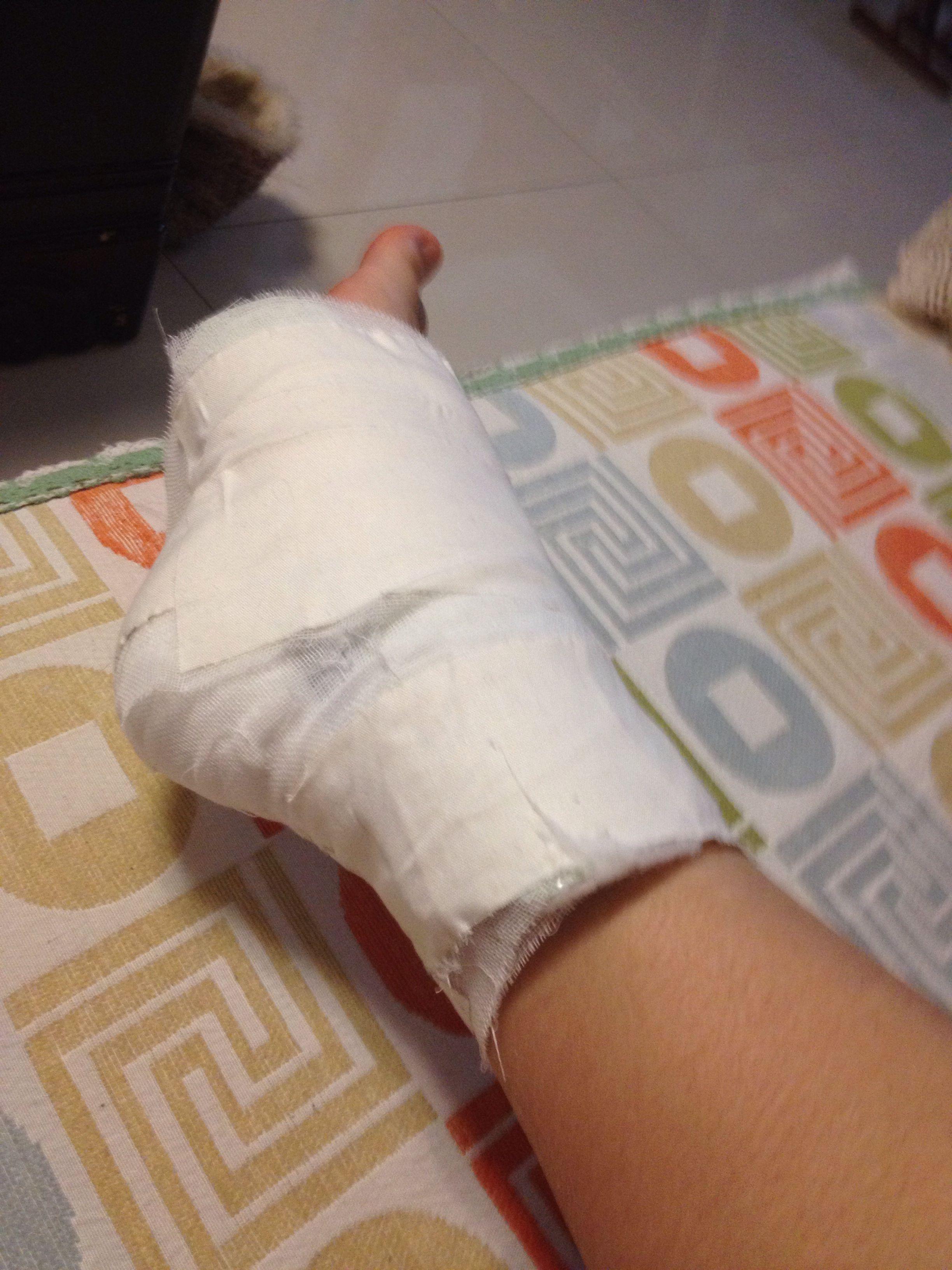 脚扭了一下就骨折怎么办