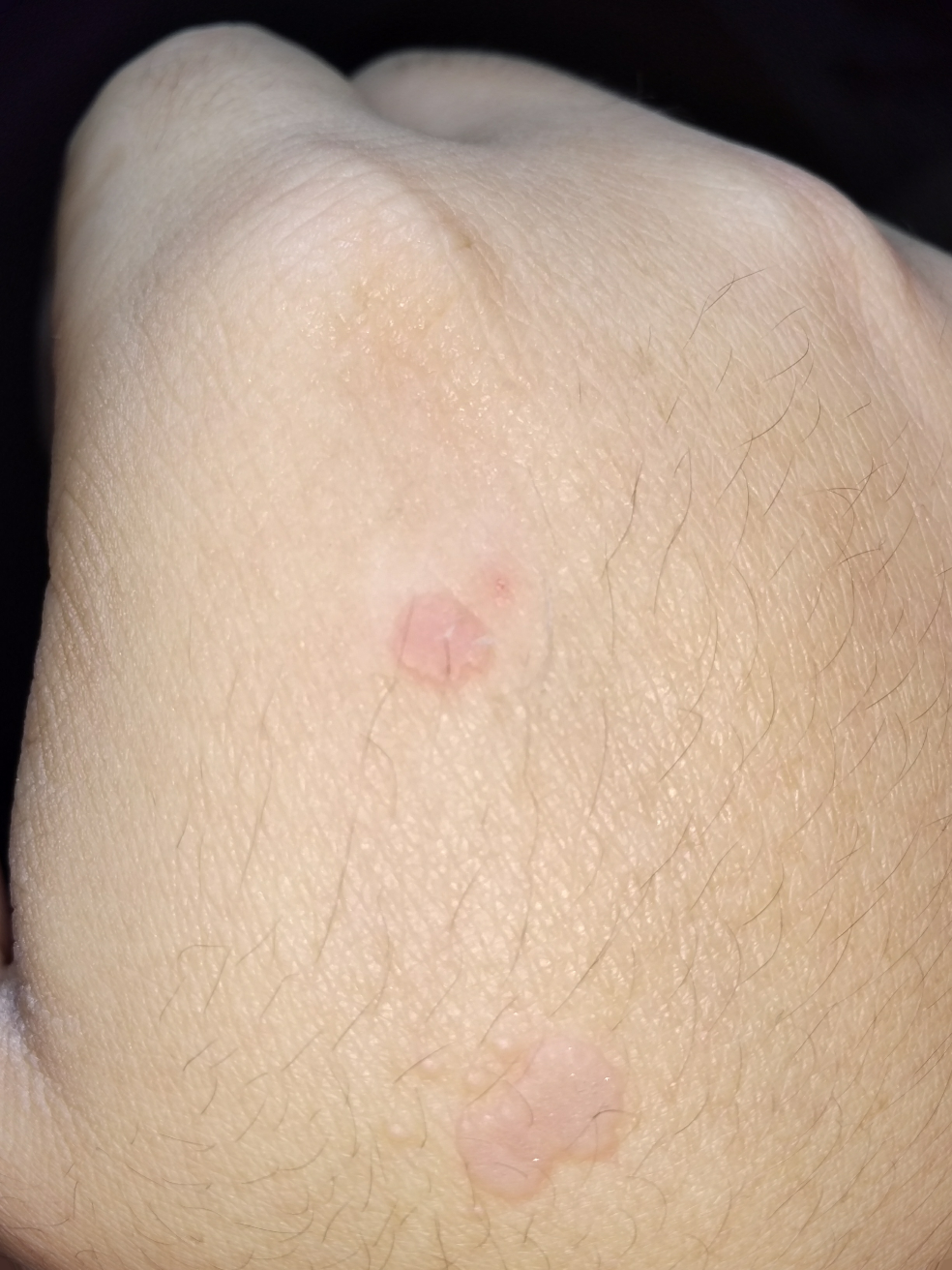 手背上这个东西是扁平疣吗我该怎么办