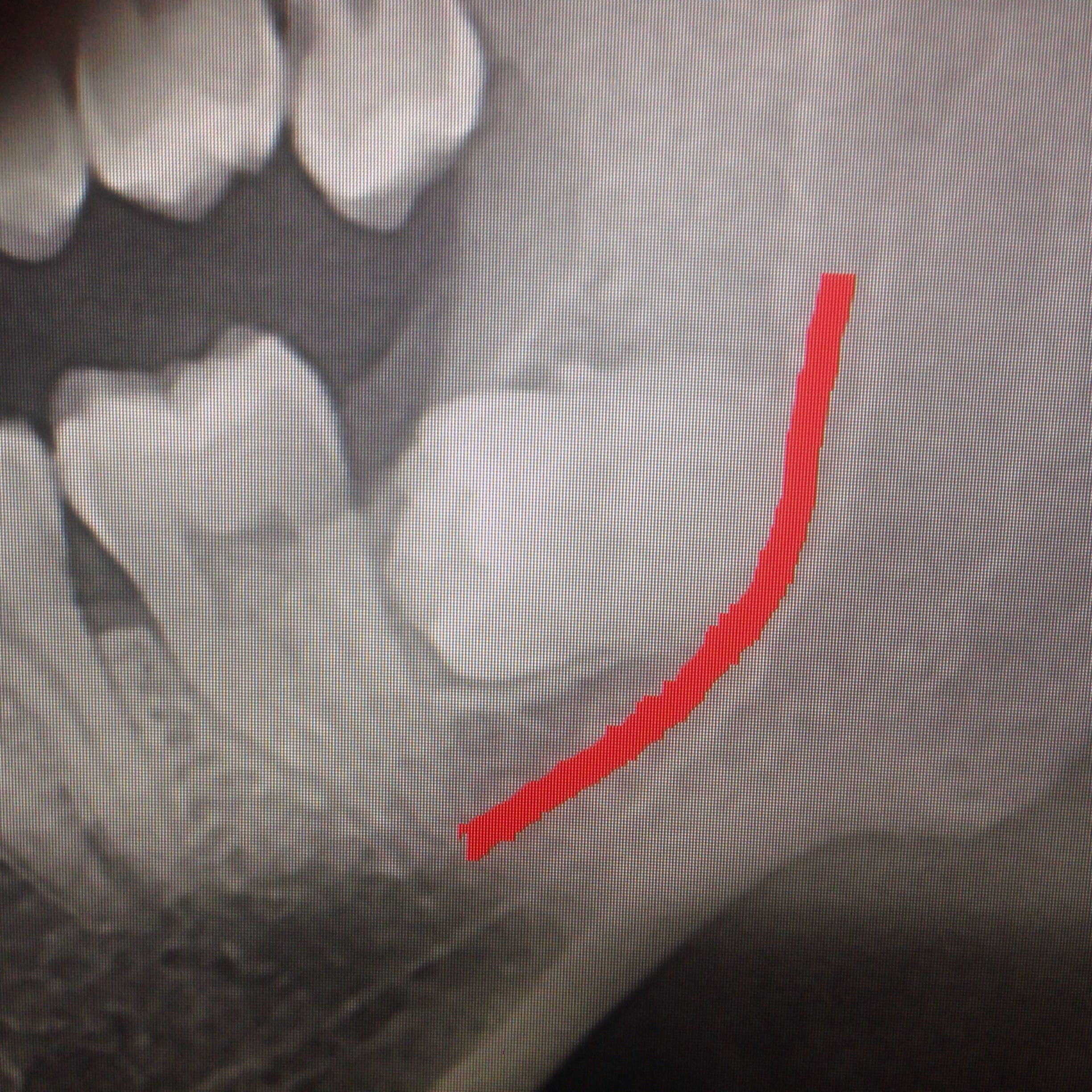 水平阻生齿拔除需要住院吗