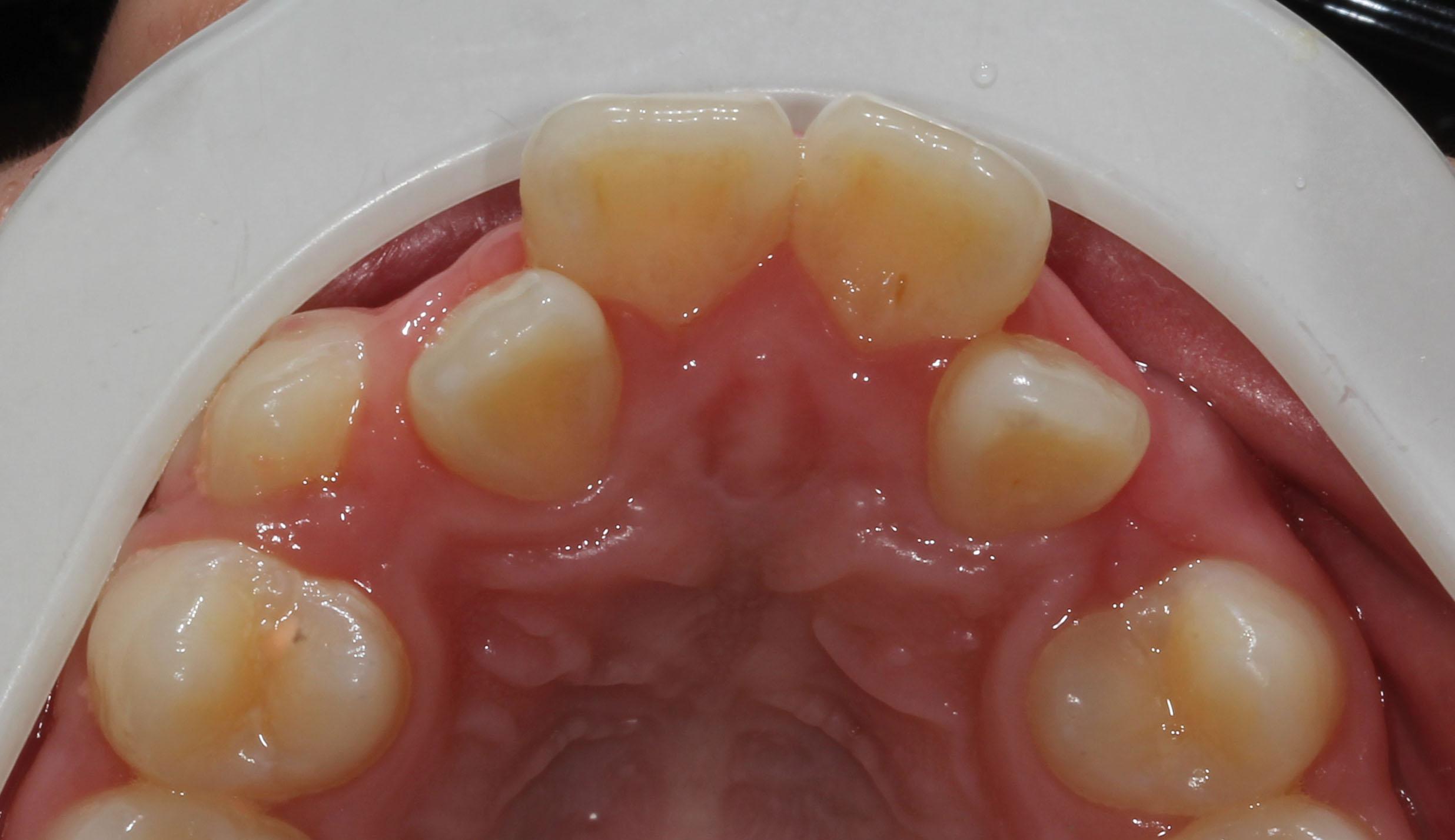 为什么许多人上颌的侧切牙是歪的