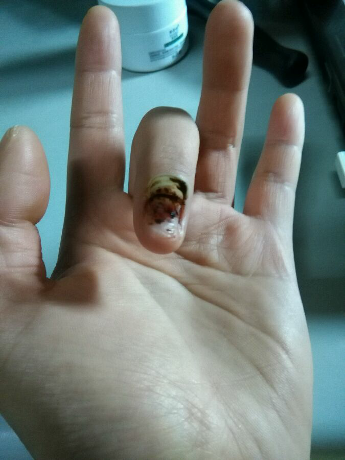 指甲被连根拔起是什么体验