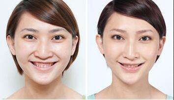 天生上唇短的人怎么办