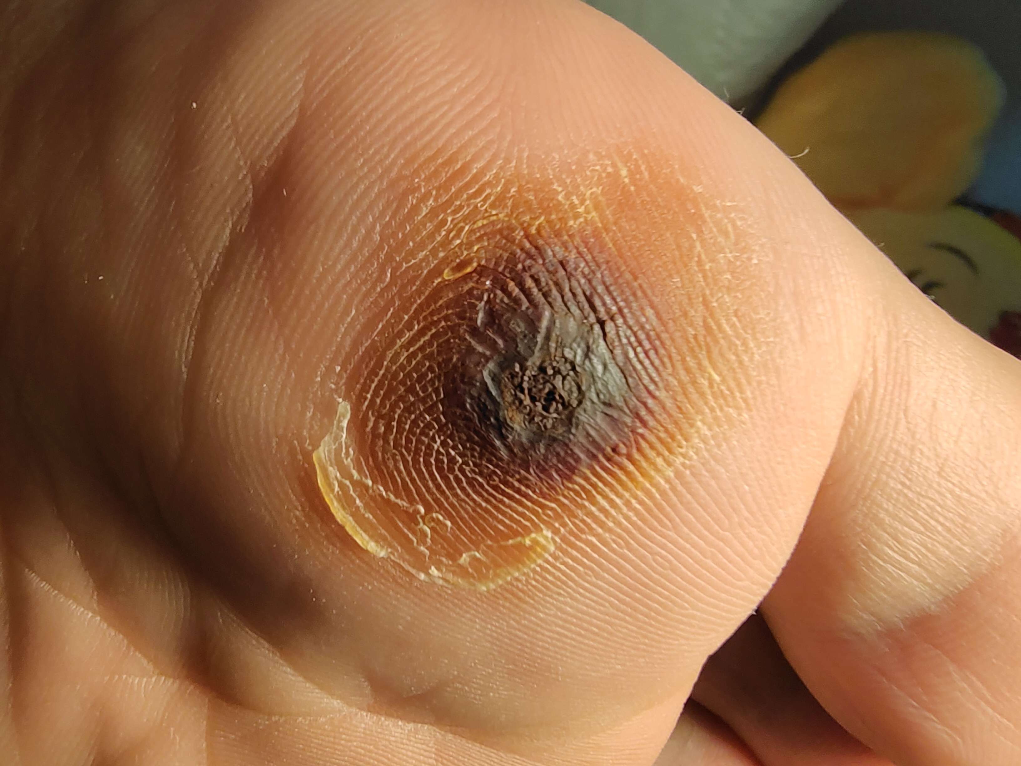 熊仔仔 的想法: 用碘酊治疗跖疣第七天,疼痛明显缓解 只… - 知乎