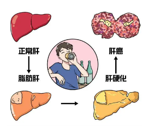 肝病罗晓岚主任 的想法: 脂肪肝,肝郁脾虚湿气重,中医这样调理 … - 知乎
