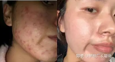 果酸灼伤是什么体验?