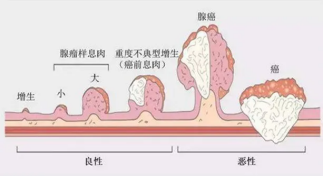 贵阳微创胃肠专科医院：纯干货：肠息肉是怎么影响人们健康的？看完赶紧把肠镜安排上~