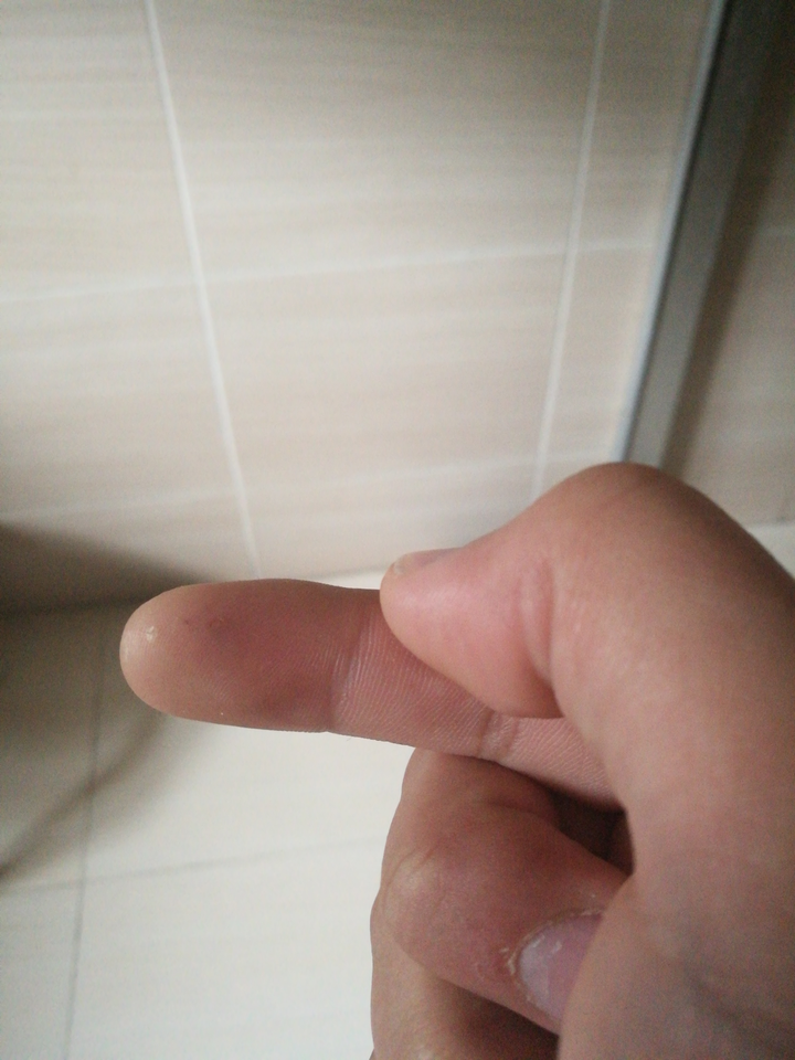 为什么被仓鼠咬了医生不让打疫苗?