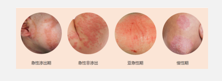 湿疹症状图