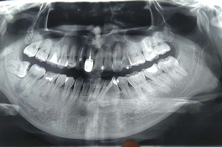 片子是之前拍的,看不出那颗断牙