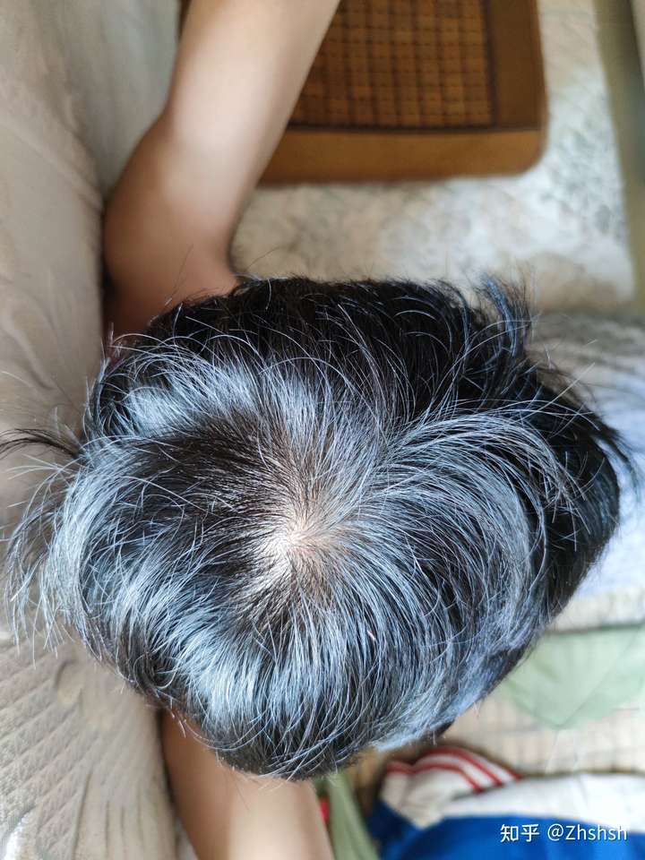 我发旋这样正常吗?