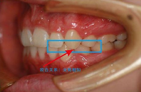 正确的咬合关系图片