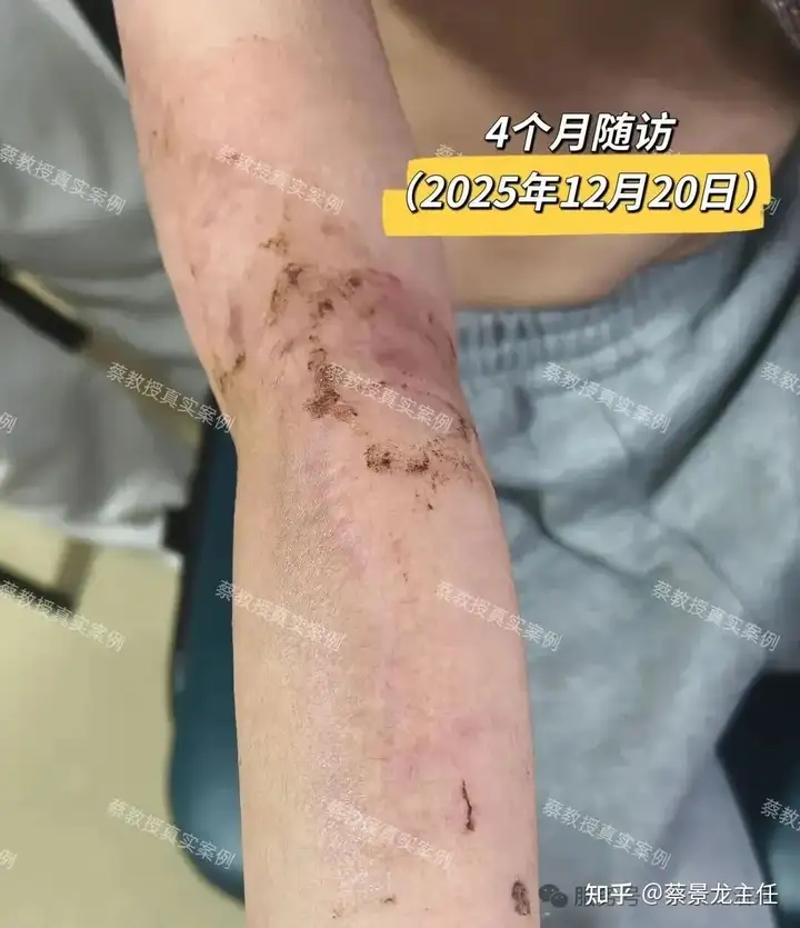 手术+激光+浅放治疗：儿童烧伤瘢痕的规范化修复之路 