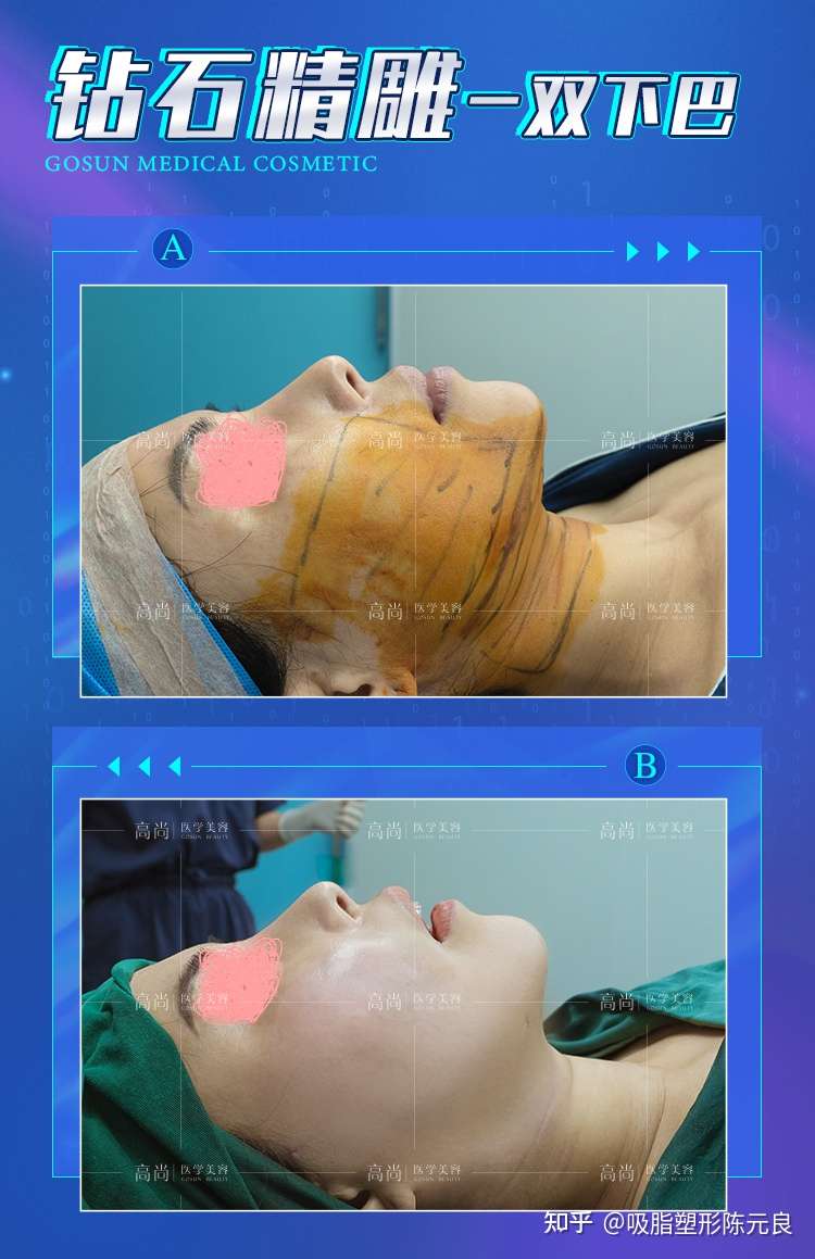 吸脂塑形陈元良 的想法: #钻石精雕# 深入身体脂肪层释放射频场