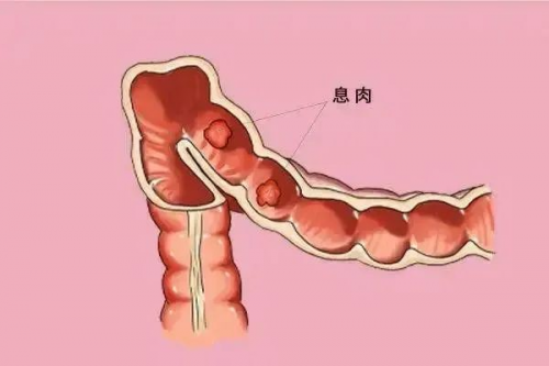 广州东大肛肠医院黑吗？拉出红色便便，当心是这几种疾病！