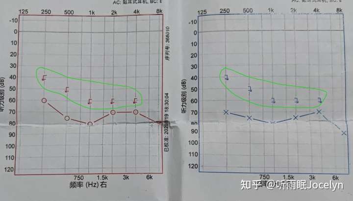 绿色圈内的为骨导听力,下面为气导听力,红色为右耳,蓝色为左耳