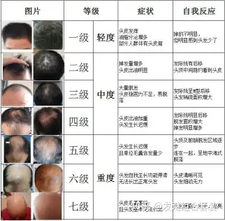 头顶稀疏算几级脱发 知乎