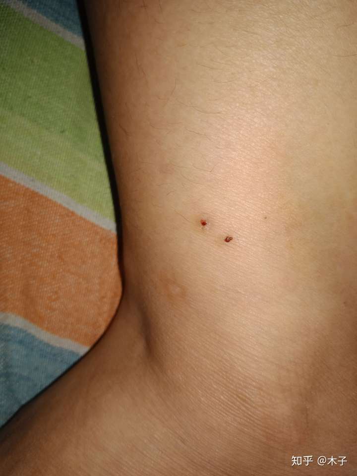 人赞同了该回答 这是什么虫子咬的 虽然不痛不痒 但是每天都有新伤口