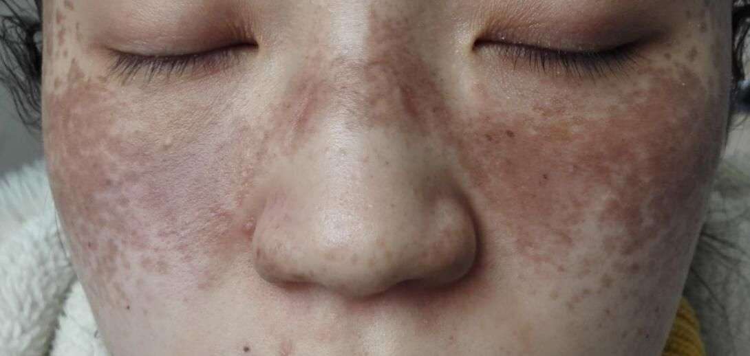 皮肤医生李志忠 的想法: 血瘀质人群具有哪些特点: 血瘀质是指体