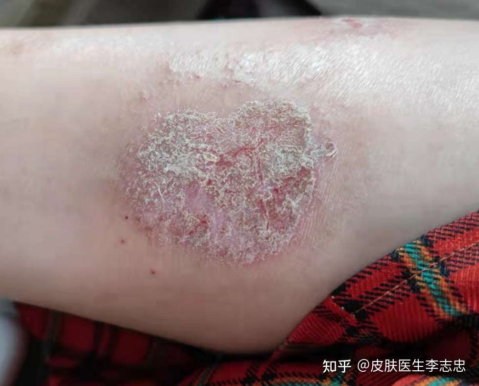 皮肤医生李志忠 的想法: #湿疹# #慢性湿疹# 脾虚血燥型慢性湿疹的