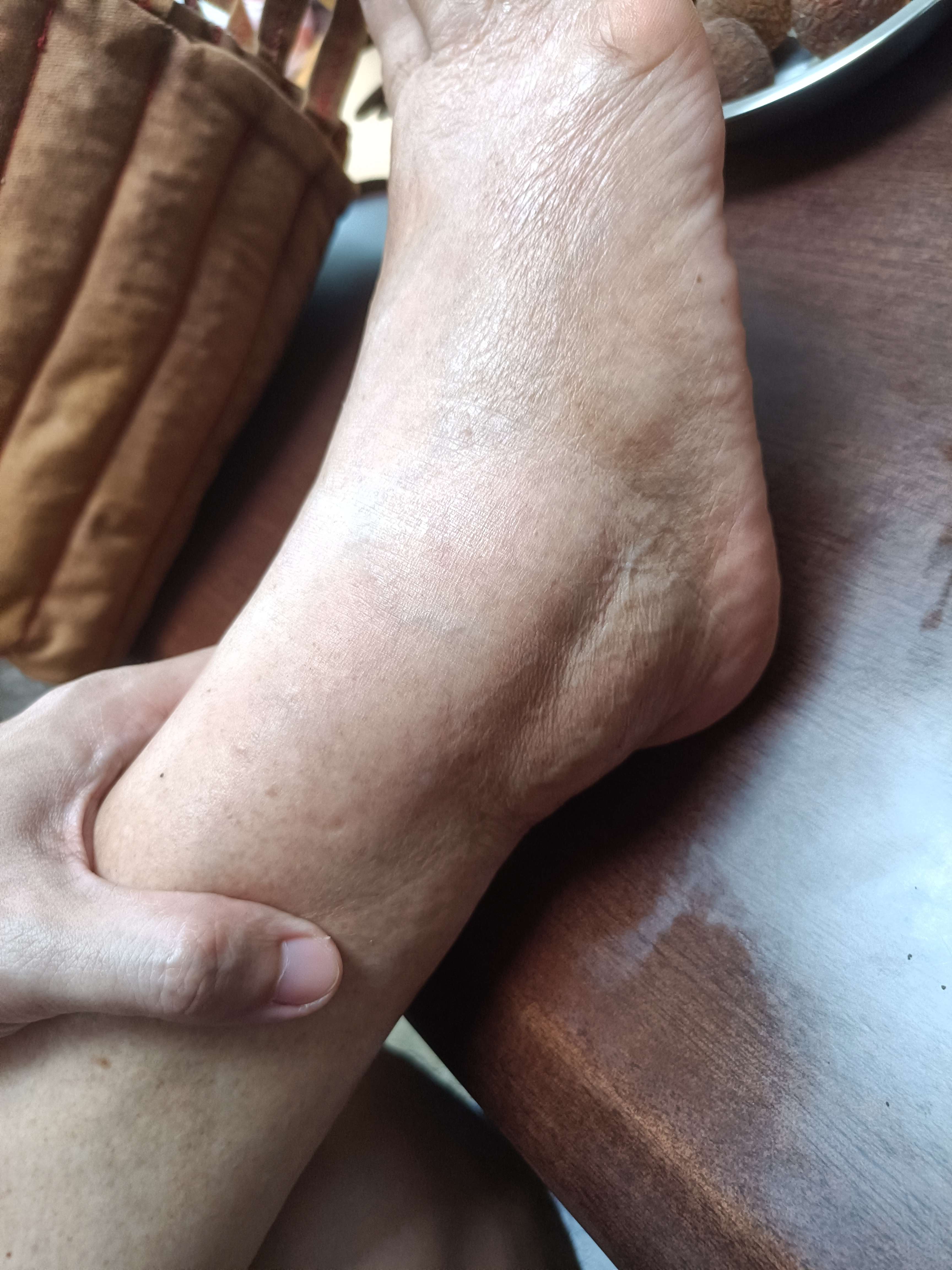 感觉 的想法: 老人家脚踝陈旧伤引发淤血青,水肿,积液