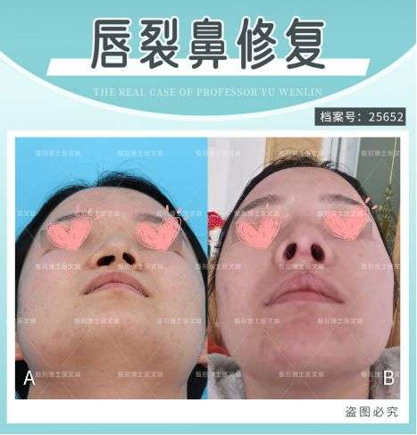 唇裂孩子为什么鼻子也塌了?专家提醒这个年龄快去修复!