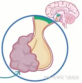 医嗓棵噪丧撤泳营徐阁躯进 Hyperthyroidism(图6)