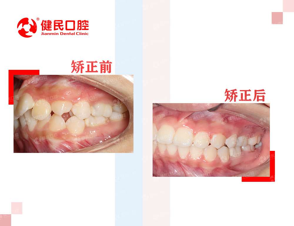 东莞健民口腔医院 的想法: 小女孩门牙的上前牙突出(龅牙)牙齿咬合