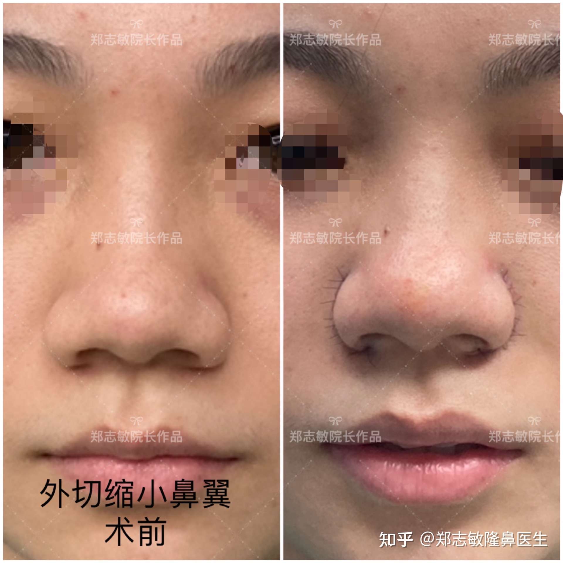 外切缩鼻翼的注意事项