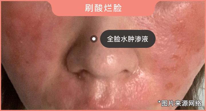 可以每天都刷酸吗?