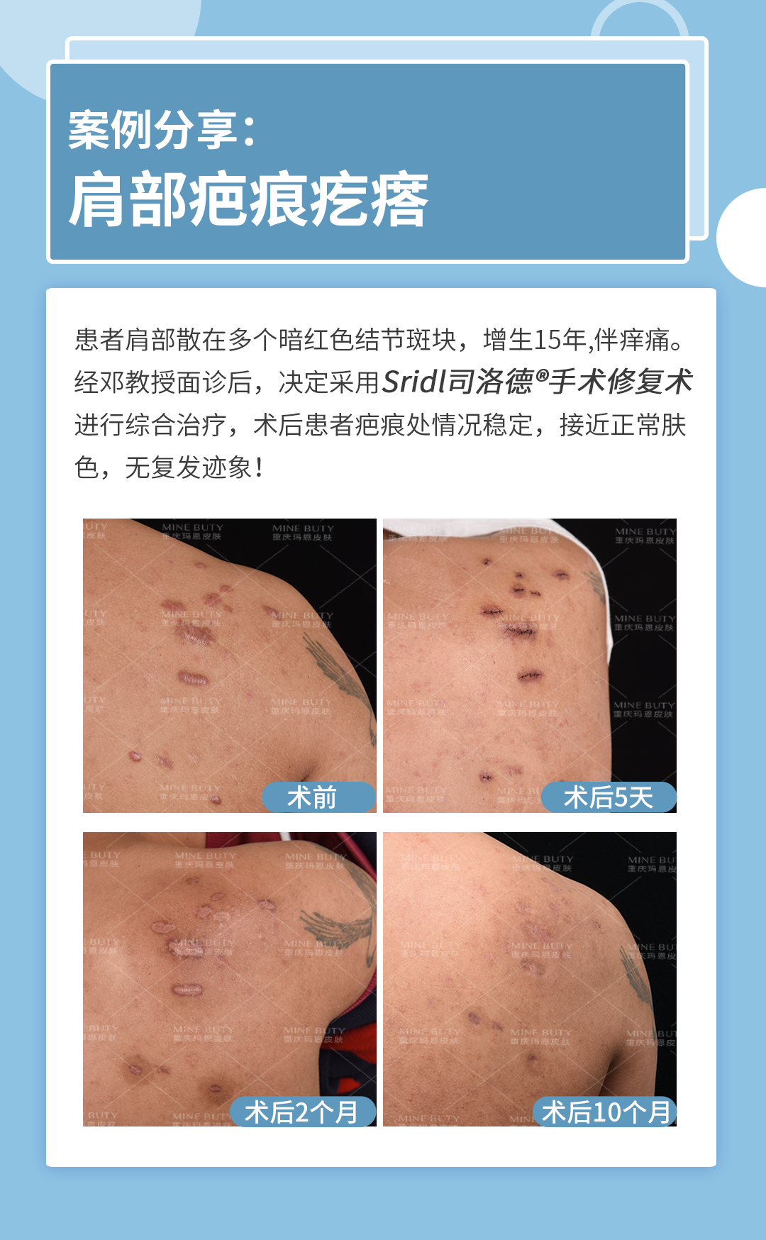 疤痕修复邓军教授 的想法: 毛囊炎导致的疤痕疙瘩主要与炎症有关!