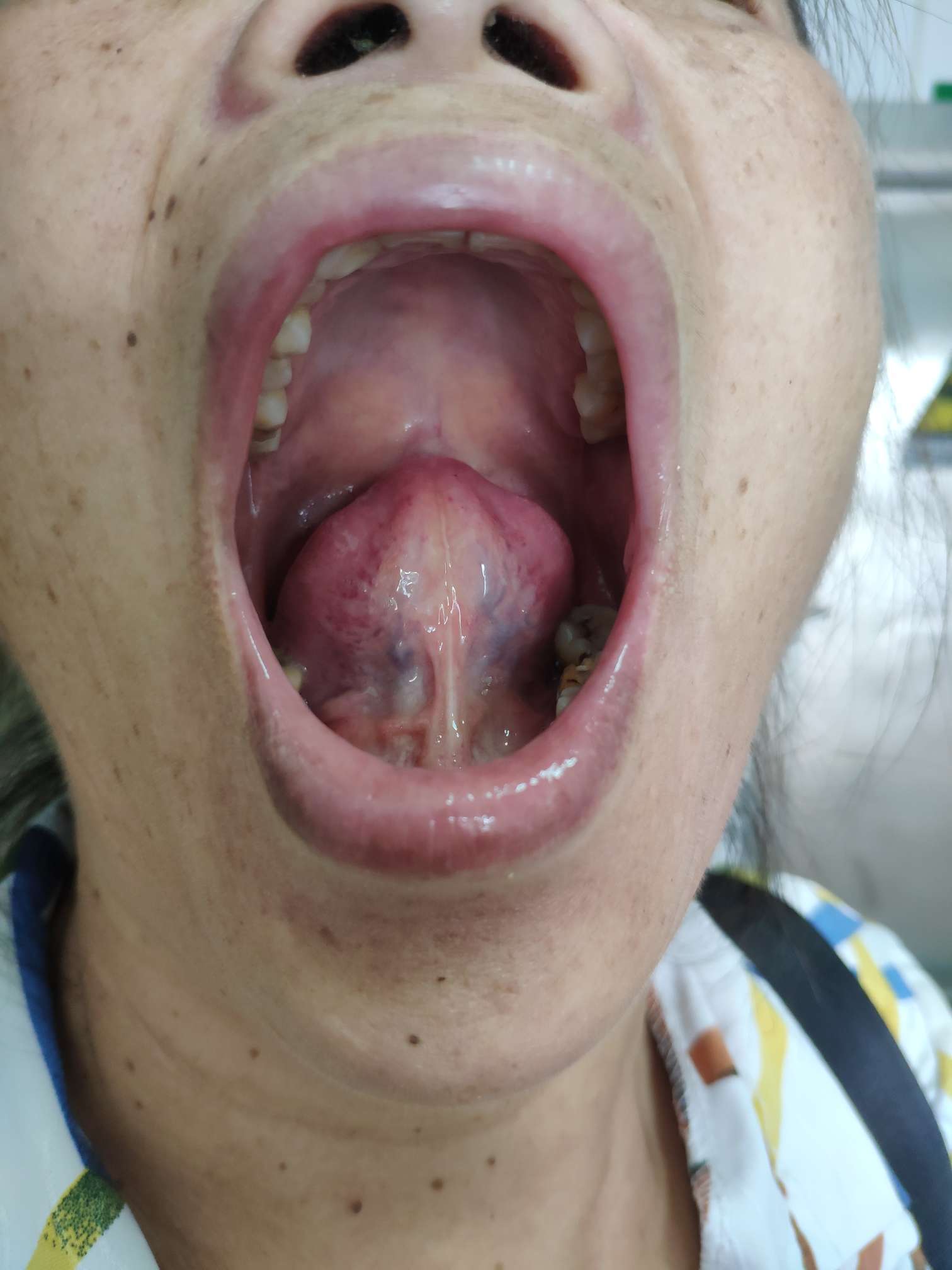 舌下癌图片凸起图片