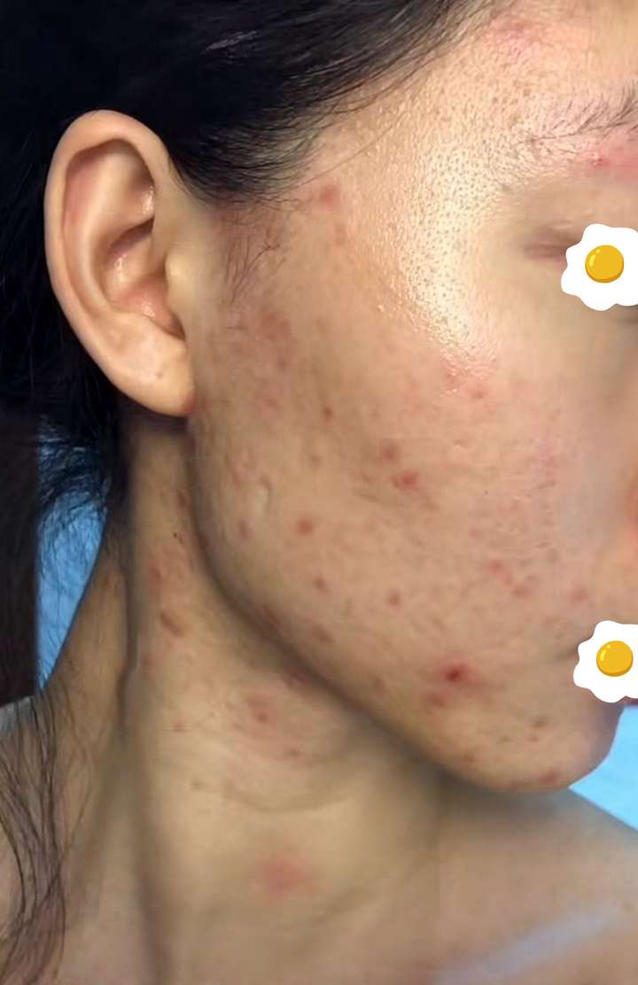 祛痘,去痘印,怎么见效快,成本低?